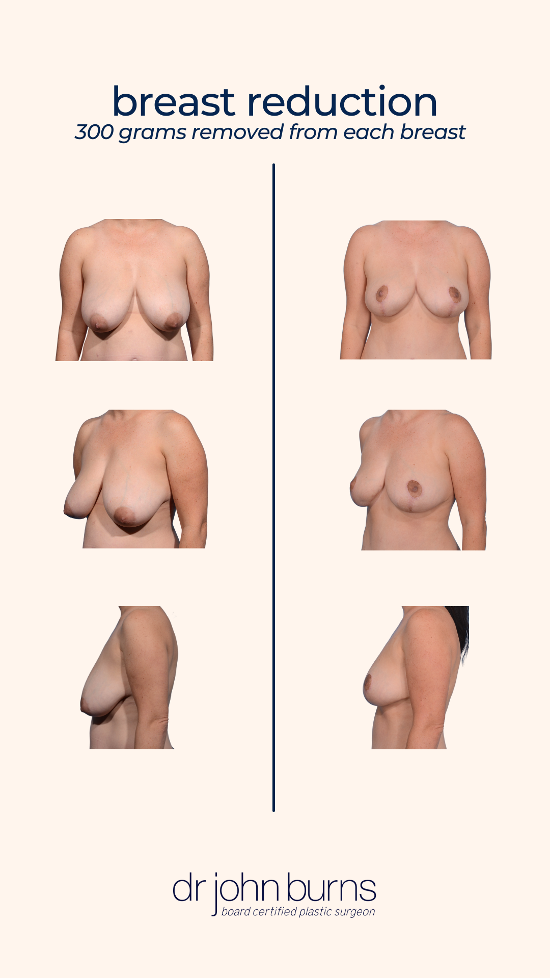 Breast Reduction in Dallas, Texas.png__PID:259506e5-a091-4307-a7ef-87ee5ac3890e
