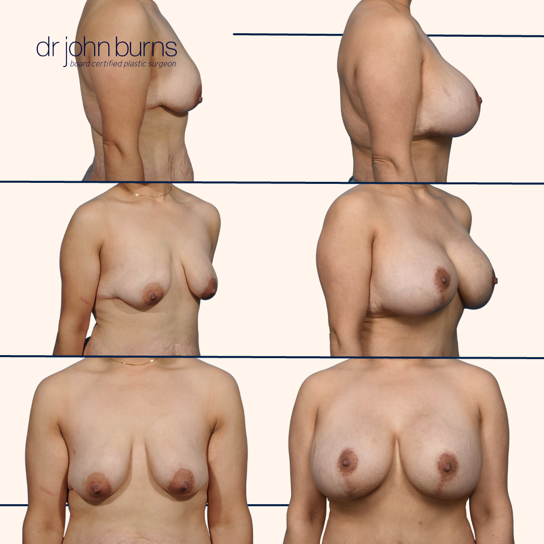 Breast implants with breast lift in Dallas, TX.png__PID:b37a66da-b45c-46db-8a72-412bce394e35