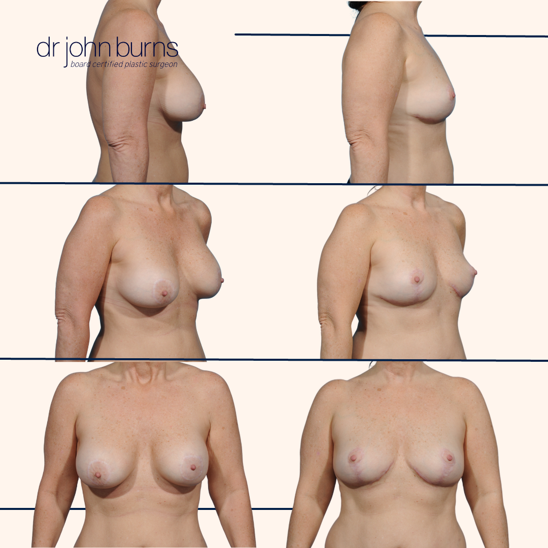 Breast lift before and after in dallas by Dr. John Burns.png__PID:c1eaddb2-9525-4fe8-8119-1d94ba3ac8e1