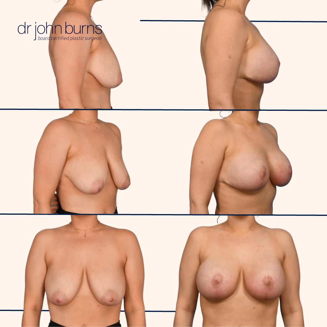 Breast lift with implants in Dallas, TX by Dr. John Burns.png__PID:7425af36-c173-4acd-9bf1-3f91db61736c