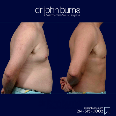 Male Liposuction by Dr. John Burns in Dallas, Texas