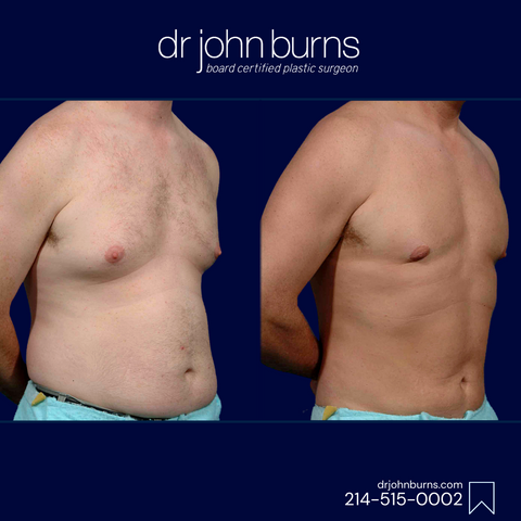 Male Liposuction by Dr. John Burns in Dallas, Texas