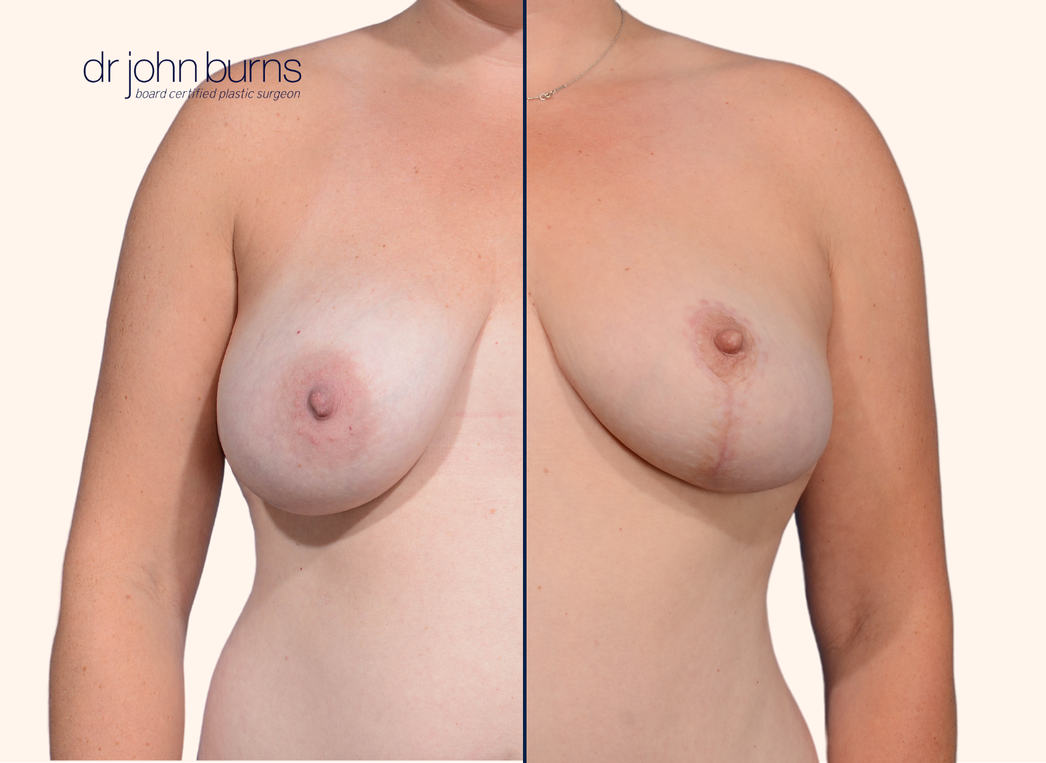 Before and after full breast lift surgery by Dr. John Burns