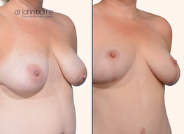 Before and after full breast lift surgery by Dr. John Burns