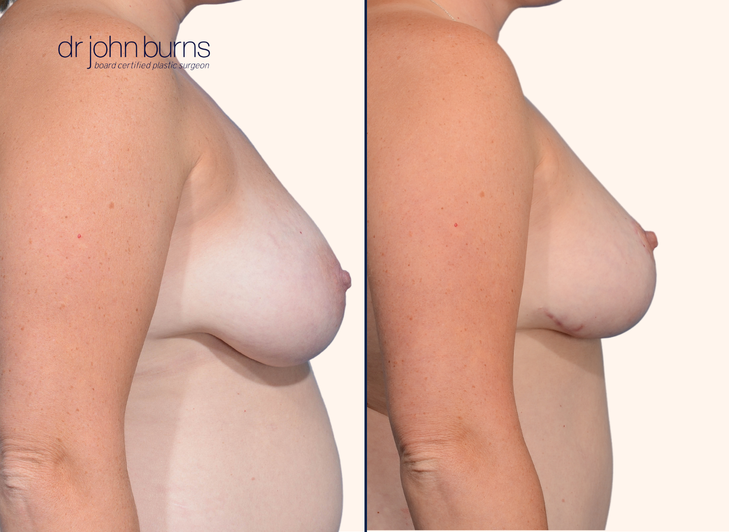 Before and after full breast lift surgery by Dr. John Burns