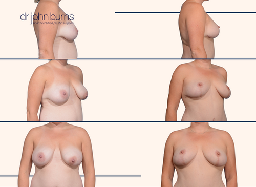 Before and after full breast lift