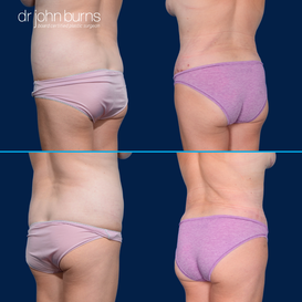 Before and After Liposuction in Dallas, Texas