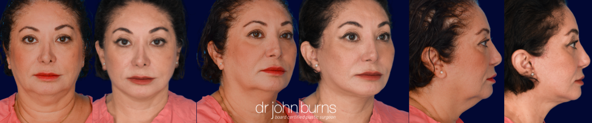 Before and after facelift at front, oblique, and profile of a hispanic woman