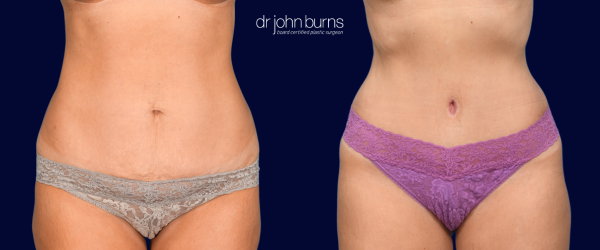 Before & After Tummy Tuck with Lipo 360 by Dr. John Burns