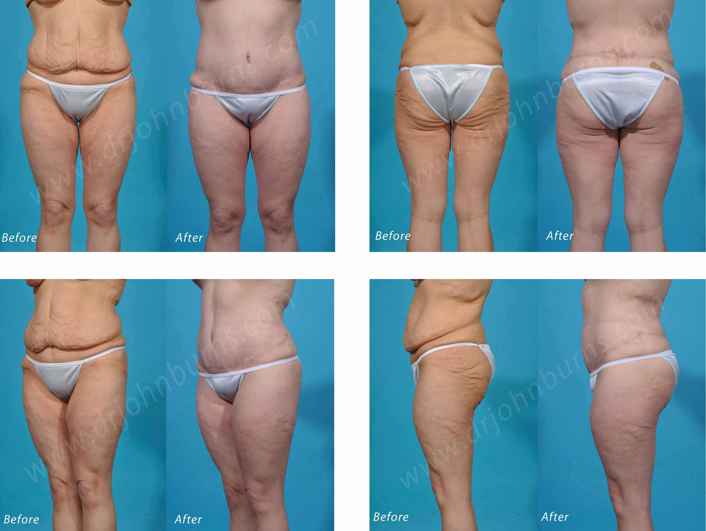 Circumferential Tummy Tuck/Lower Body Lift Photo Gallery – Dr John