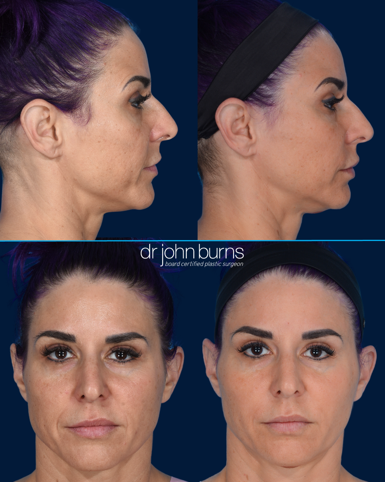 Before and After Fat Grafting to Face | Dallas Fat Transfer | Dr. John Burns