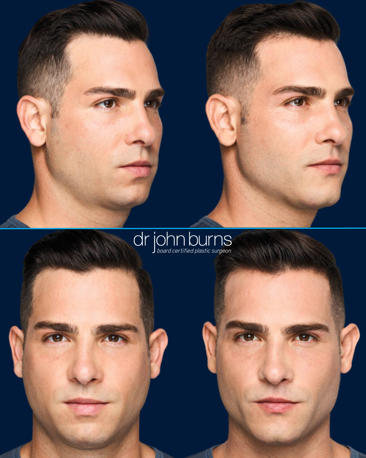 Before and after Juvederm Volux to Chin and jawline