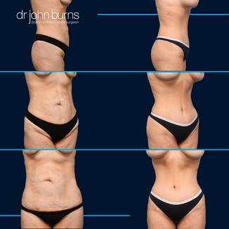 Before and after corset tummy tuck with lipo 360