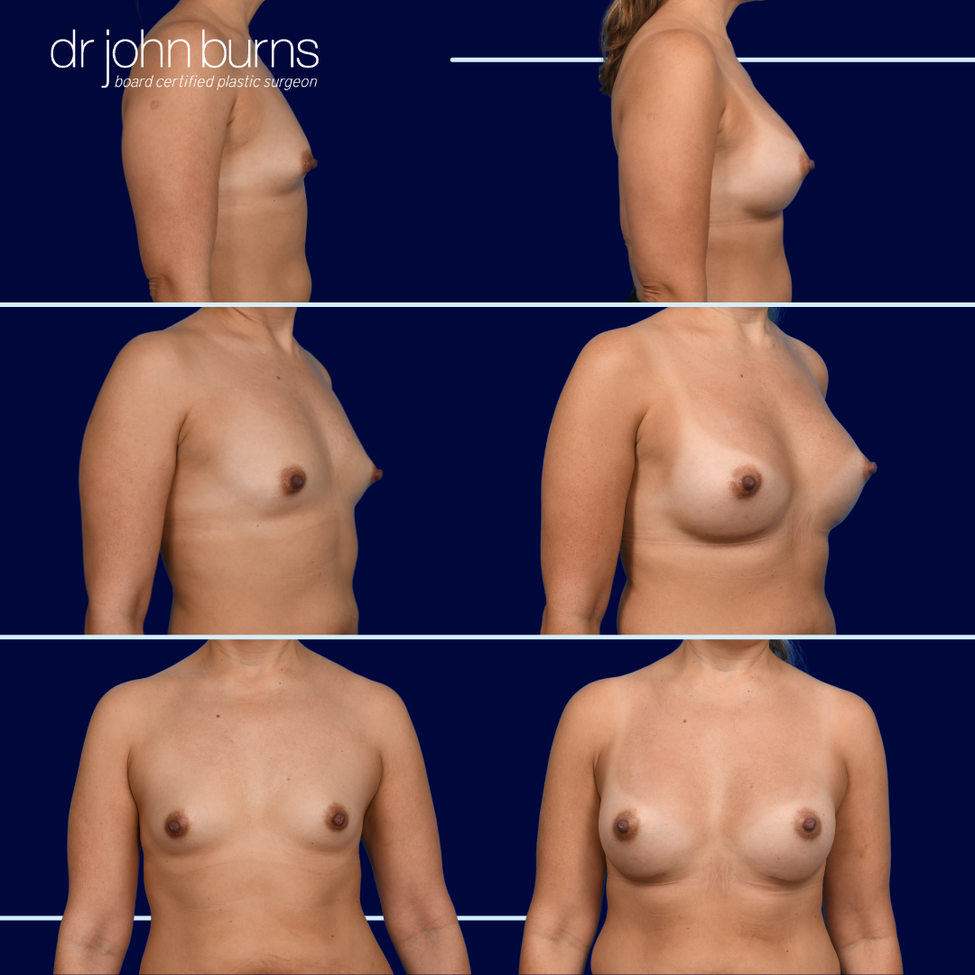 Breast Augmentation to Correct Tuberous Breast Deformity by Dr. John Burns MD