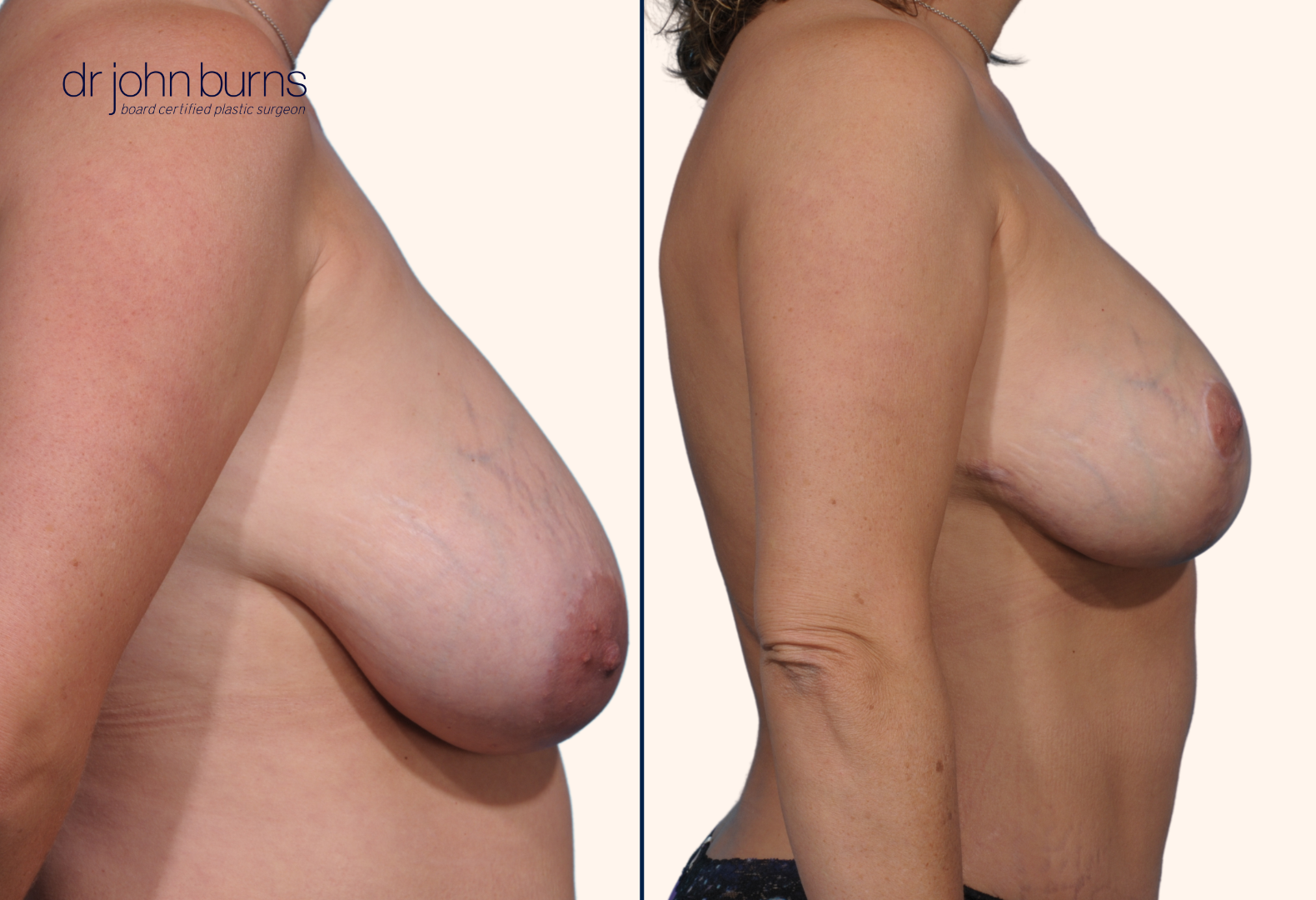 Breast reduction before and after by Dr. John Burns