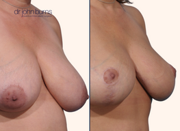 before and after breast lift surgery 