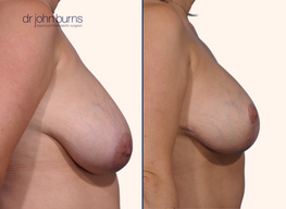 before and after full breast lift