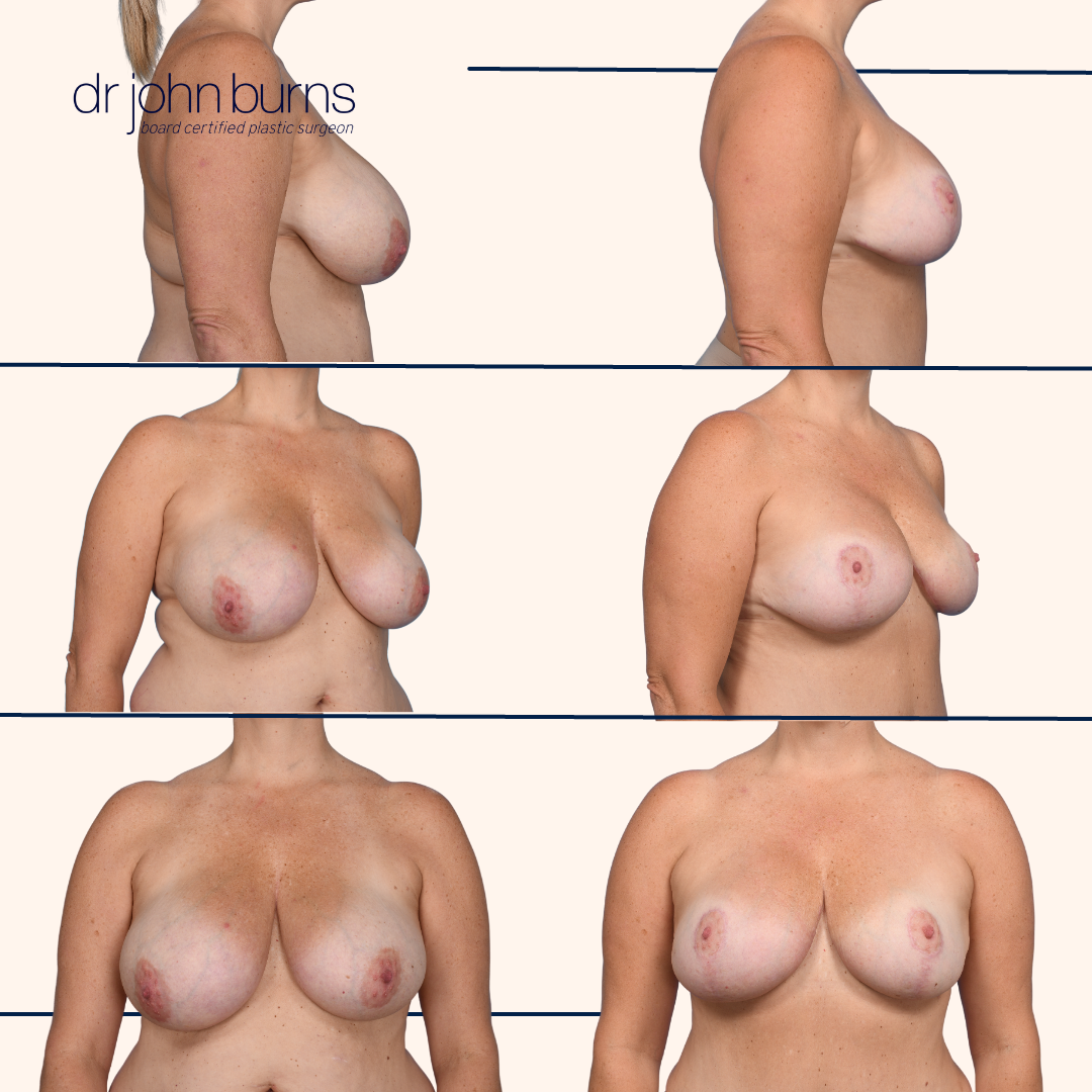 Dallas Breast Lift Before and After | Dr. John Burns.png__PID:c074e734-026b-4144-bfc9-c404bdb41264