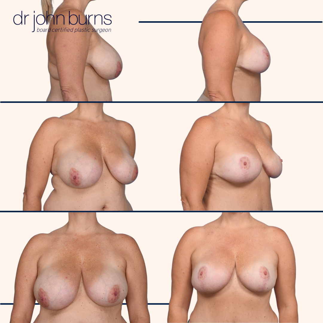Dallas Breast lift surgeon.png__PID:d6b16655-8fc4-4079-b73c-b33205db77e9