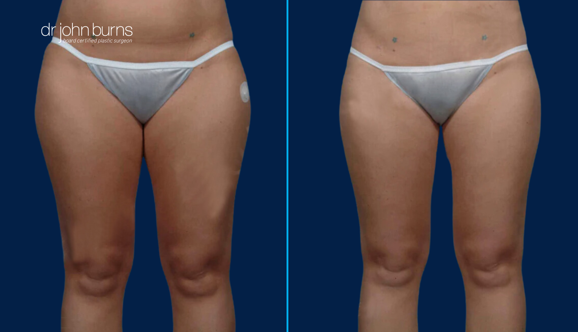 Dallas Thigh Lift- Before and After- Dr. John Burns MD.png__PID:263d516d-1b08-4736-b73c-33387e90d348