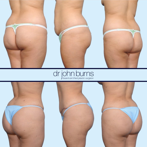 Skinny Brazilian Butt Lift, Buttock Augmentation, Dr. John Burns, Dallas, Texas