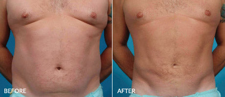 Liposuction and Body Contouring for Men – Dr John Burns