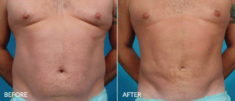 liposuction for obese men