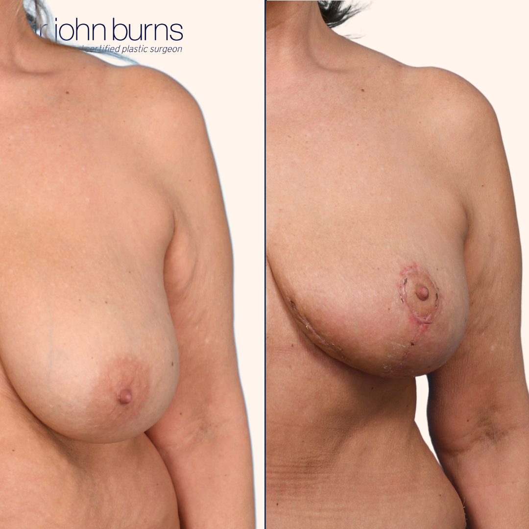 Before and after Areolar Reduction in Dallas, Texas by Dr. John Burns MD