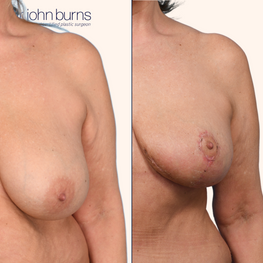 Before and after breast lift by Dr. John Burns in Dallas, Texas