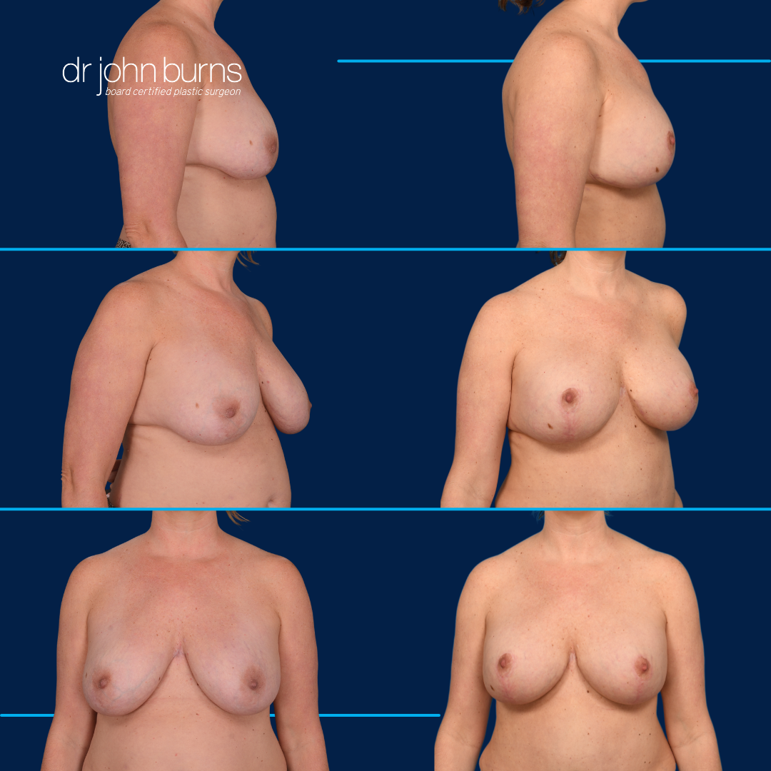 Explant Surgery with Fat Transfer in Dallas, Texas.png__PID:0aad0d1c-d76e-470e-953b-704637c6311e