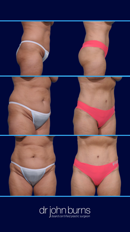 Extended Tummy Tuck in Dallas, Texas- Dr. John Burns- Before and After.png__PID:b10c7bb5-4ea7-4360-a464-872ac9358c7e