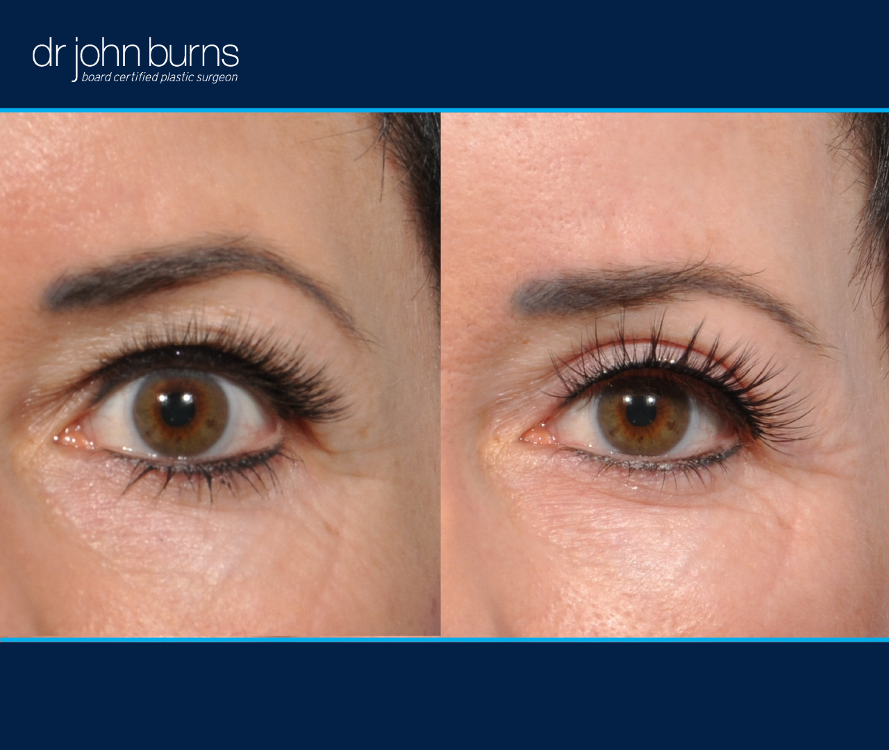 left eye view | before and after eyelid surgery results by Dr. John Burns
