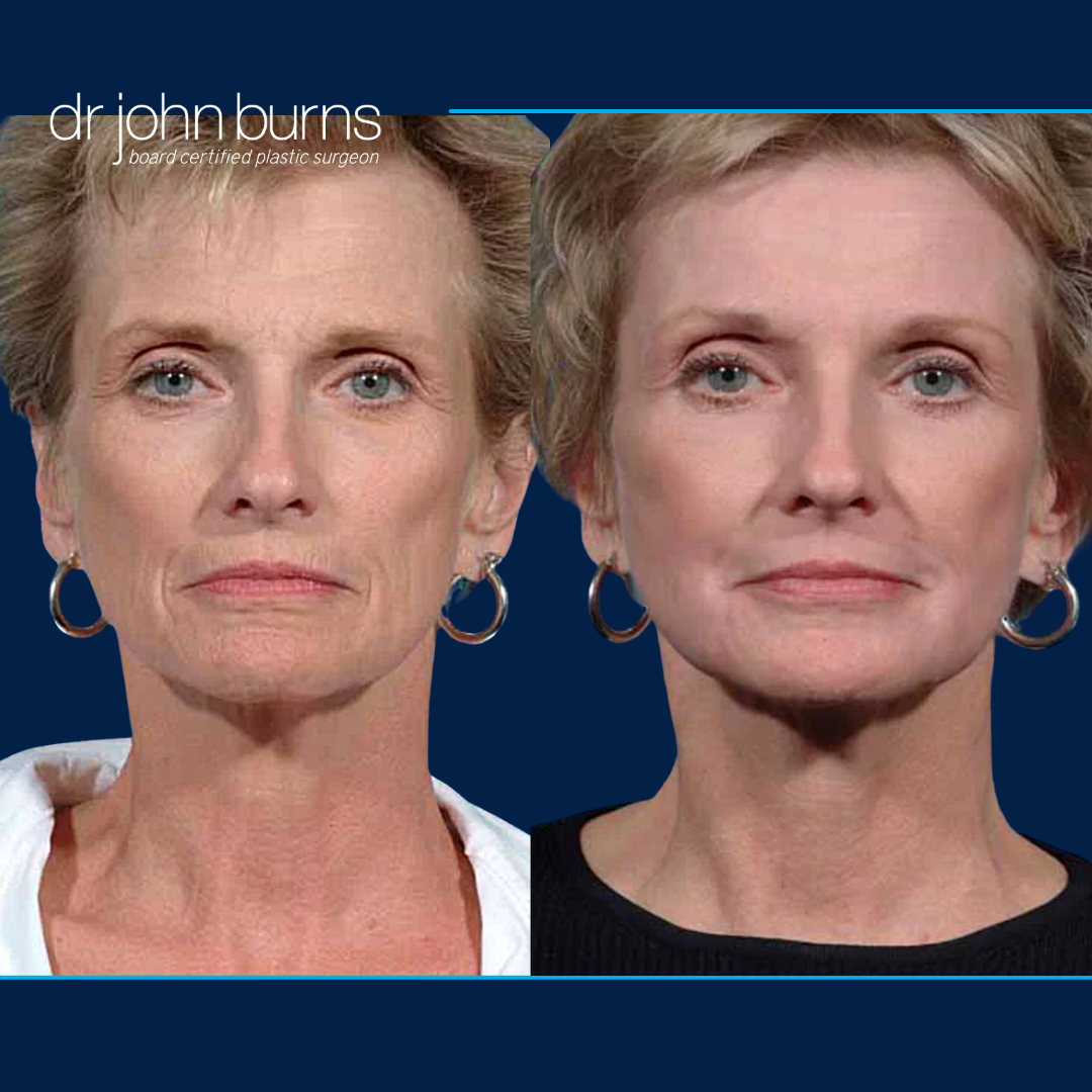 Facelift with Laser Resurfacing by Dr. John Burns in Dallas, Texas