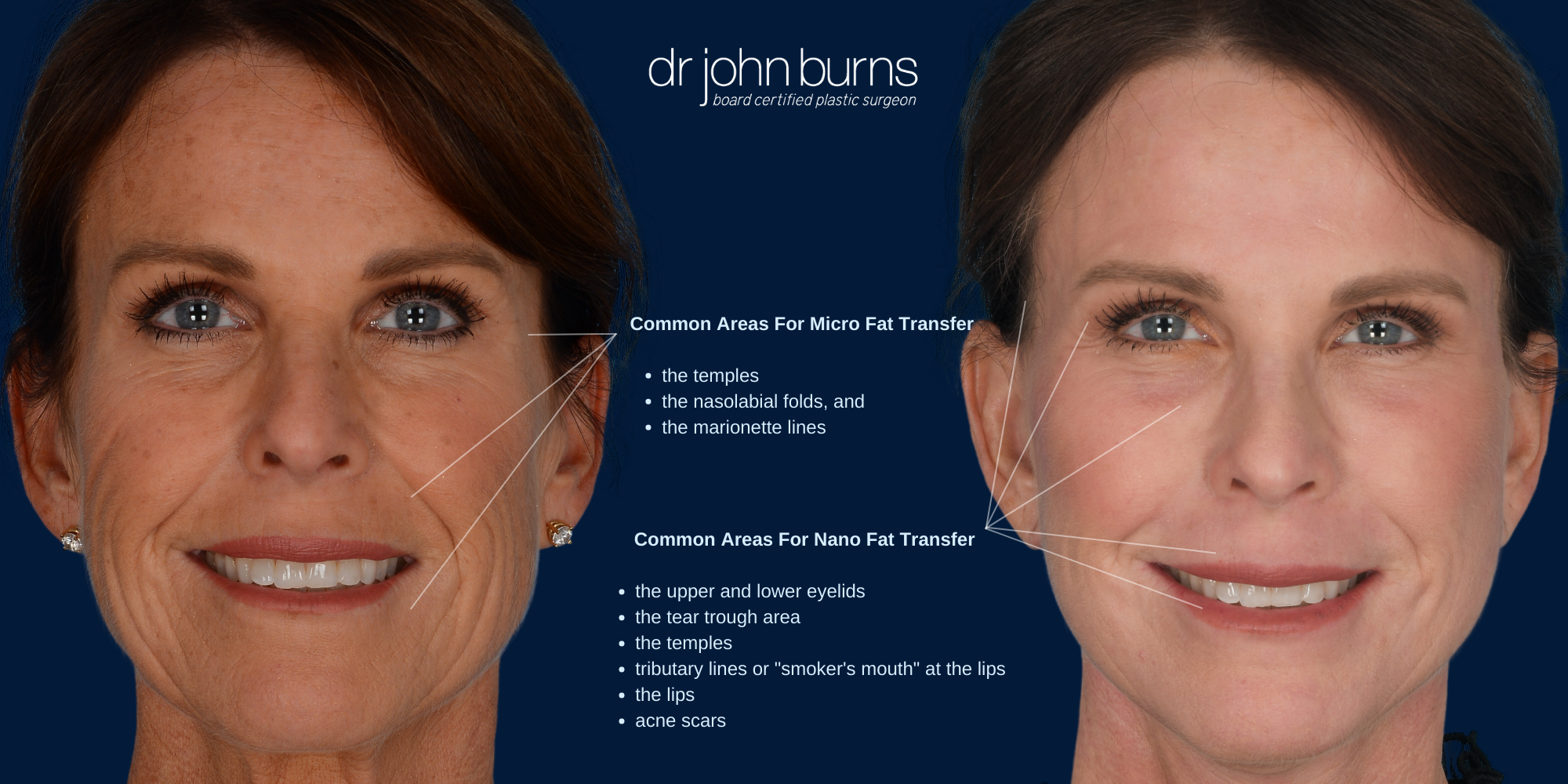 Facial Fat Grafting Injection Sites | Dallas Fat Grafting | Dr. John Burns 