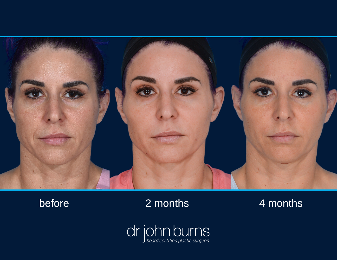 Healing Process | Month by Month | Facial Fat Transfer