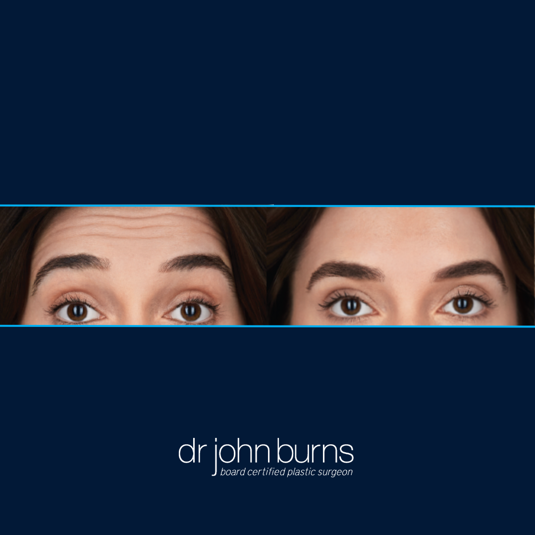Female Botox Before and After, Dallas, TX, Dr. John Burns.png