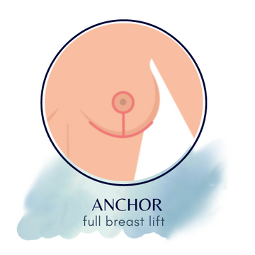 full anchor breast lift incision line placement