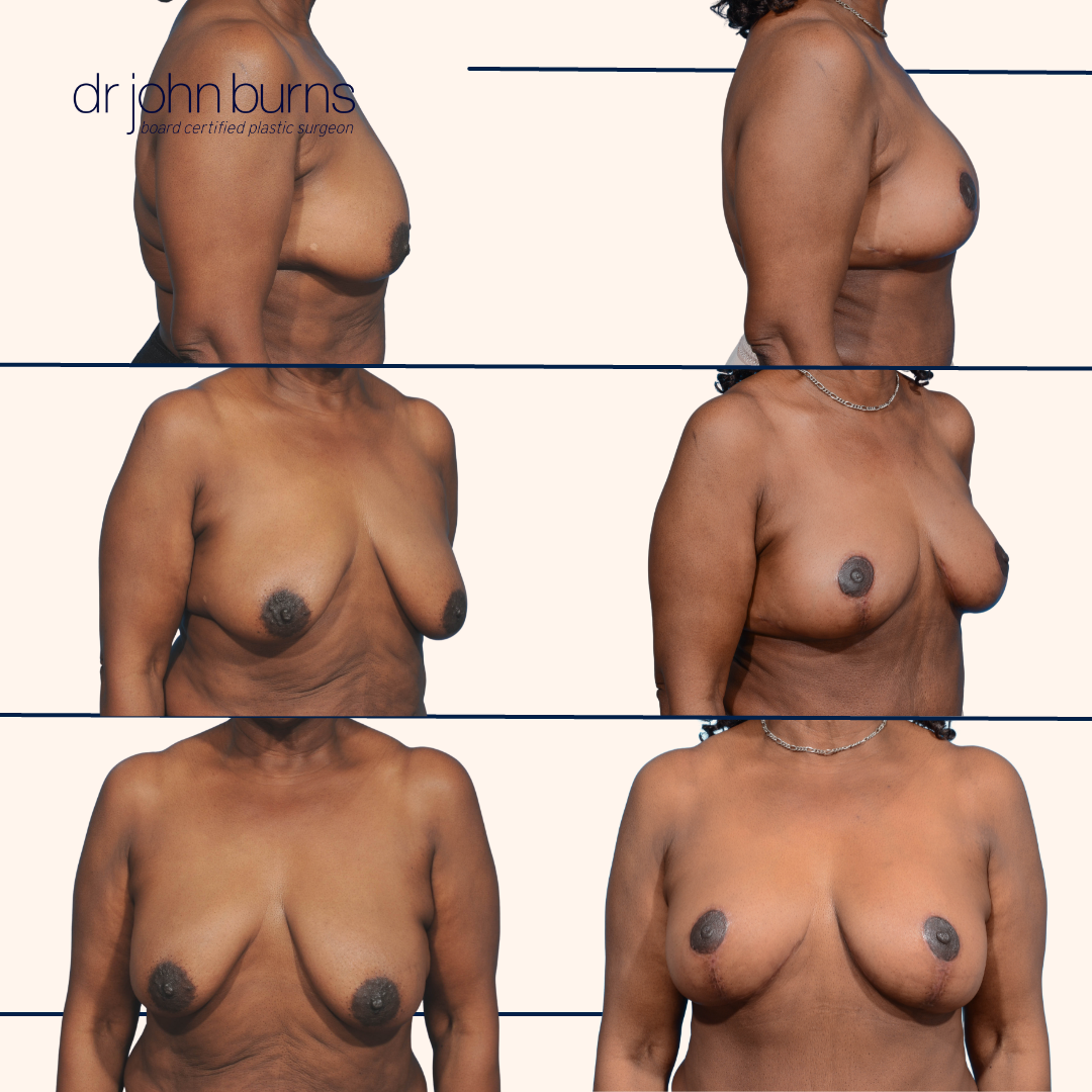 Full Breast Lift Results in Dallas TX | Dr. John BUrns.png__PID:9225d2ae-9ffc-4654-adcb-5c5880ff04e2