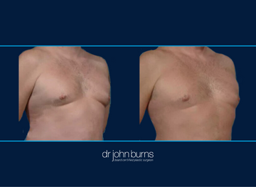 Before After Gynecomastia Surgery Dallas by Dr. John Burns