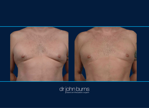 Gynecomastia Before and After Results in Dallas, Tx- Dr. John