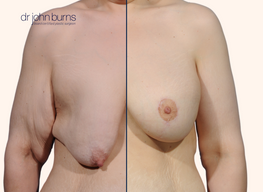 before and after breast lift with breast implant after weight loss surgery