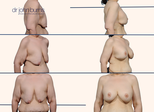 before and after breast lift with breast implant after weight loss surgery