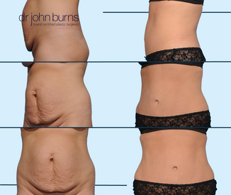 before and after tummy tuck surgery by Dallas Plastic Surgeon, Dr. John Burns