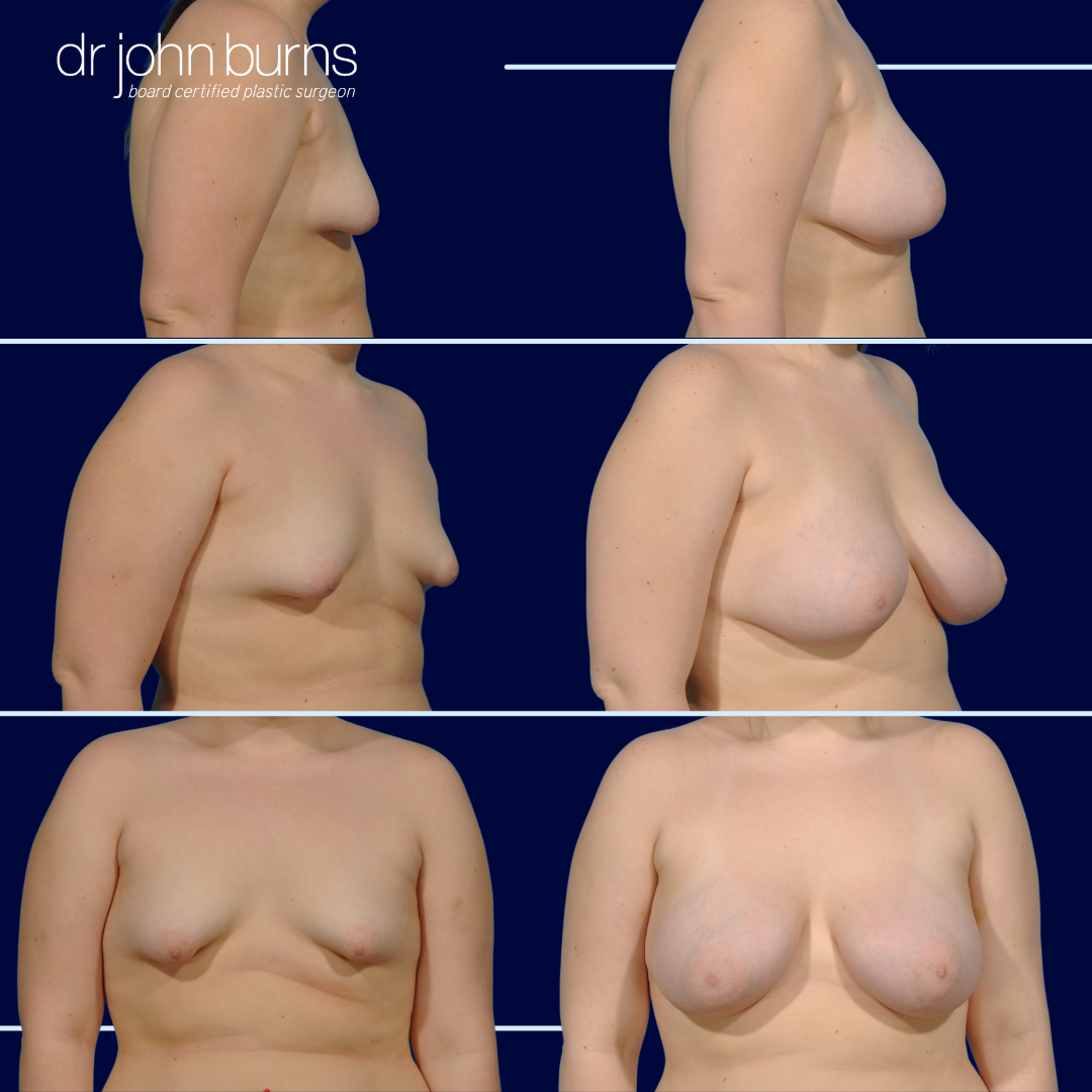 Breast Augmentation to Correct Tuberous Breast Deformity by Dr. John Burns MD
