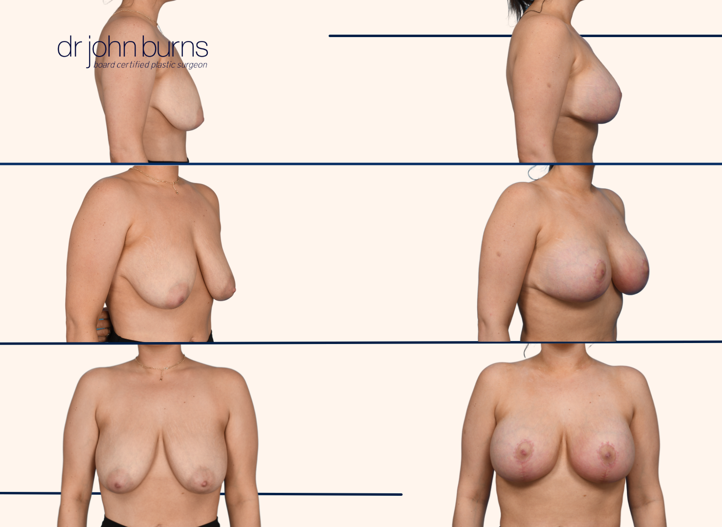 Before and after breast lift with breast implants