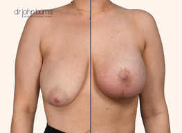 Before and after breast lift with breast implants 