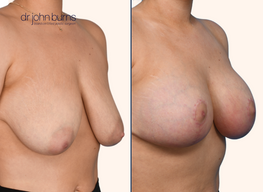 Before and after breast lift with breast implants