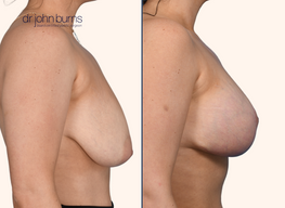 Before and after breast lift with breast implants