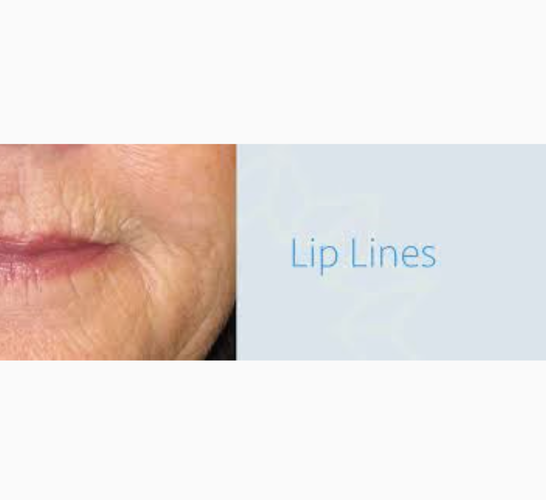 How To Treat Lip Lines- Dr. John Burns.png__PID:310b1a0a-d879-4595-8d82-a3a7567bab97