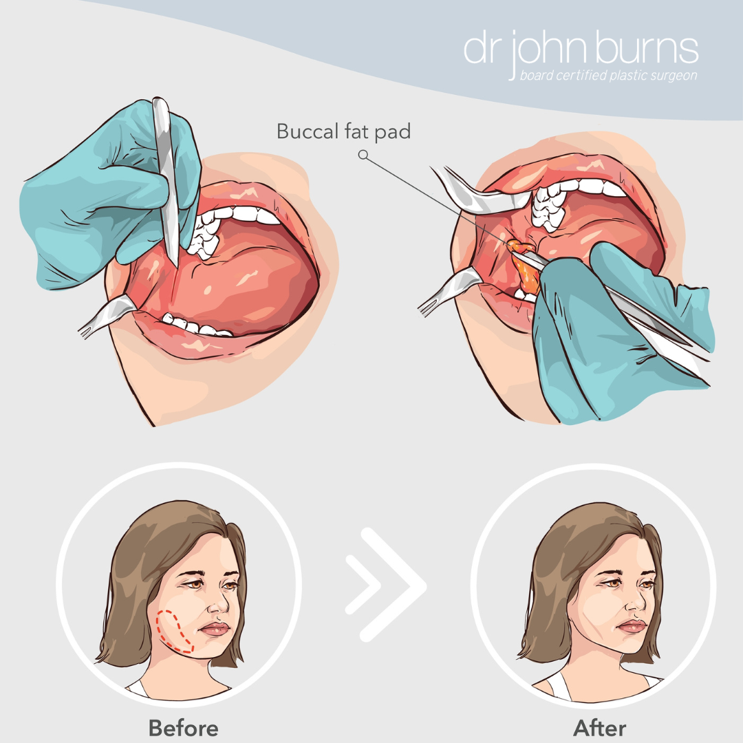 How is buccal fat removal done in Dallas TX?- Dr. John Burns.png__PID:ba1e9d4f-29ce-4650-96d0-44ea8dc4c3d3